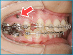 歯科矯正用アンカースクリュー（※）を用いた矯正歯科治療